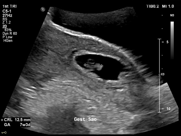 Thai bám sẹo mổ lấy thai (Cesarean section scar pregnancy)