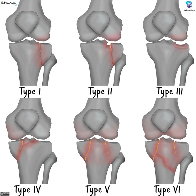 Gãy mâm chày (Tibial Plateau Fracture)