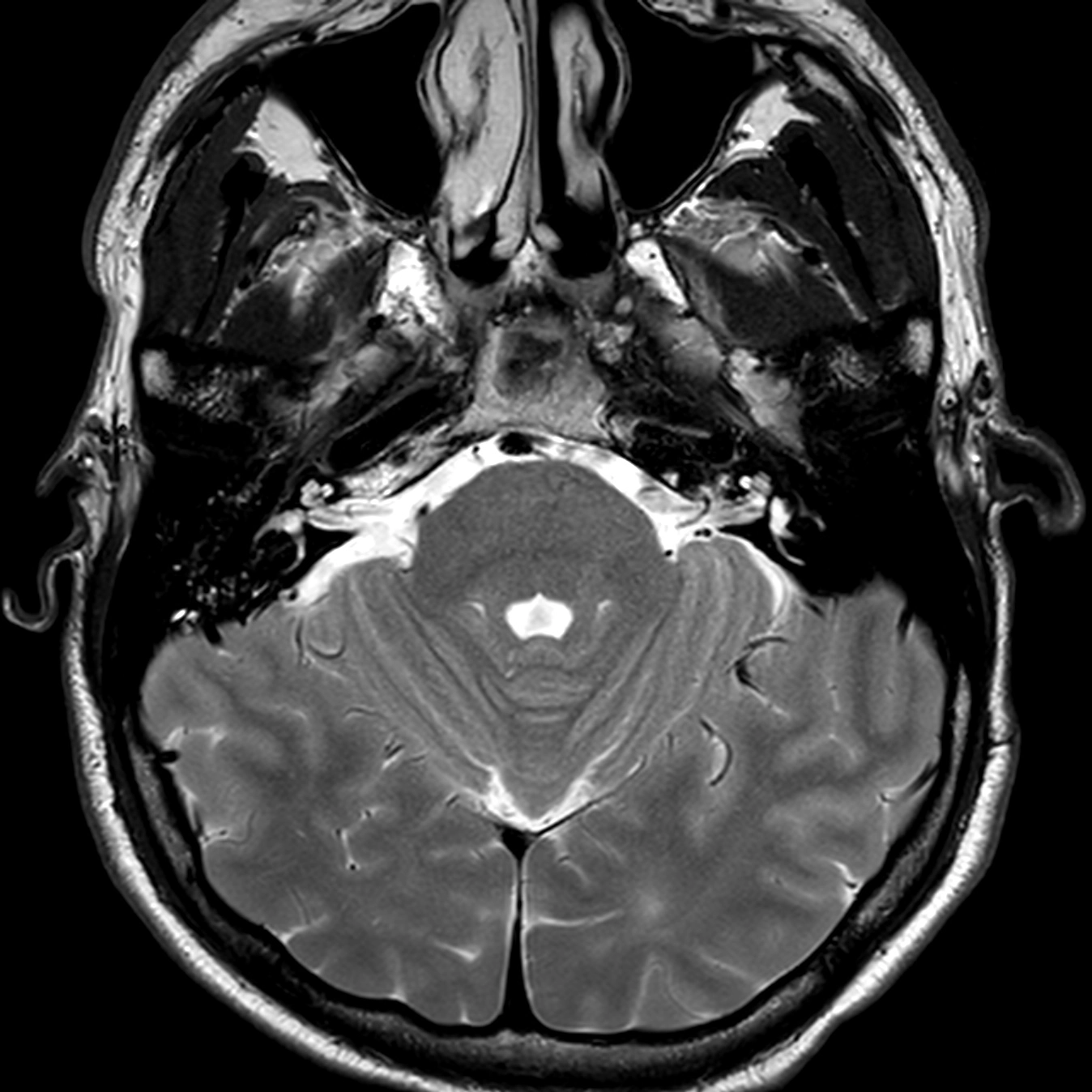 Thoát vị não thái dương (Temporal encephaloceles)