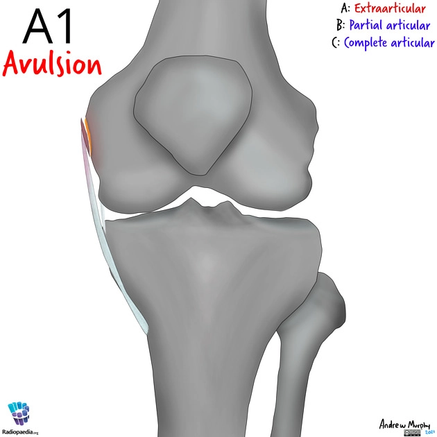 Gãy đầu dưới xương đùi (Distal femoral fracture)