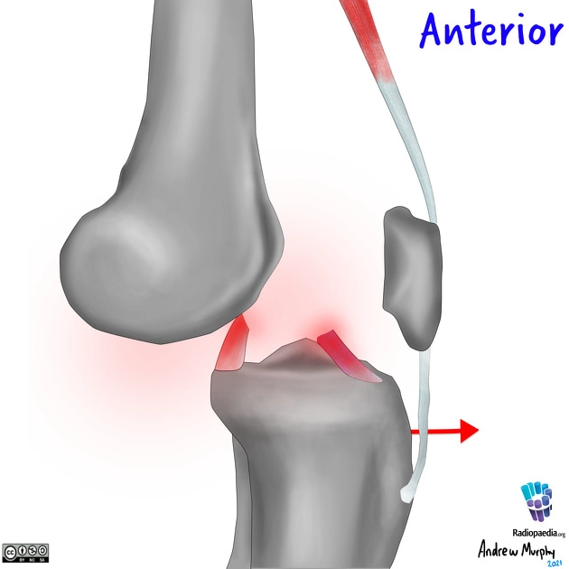 Trật khớp gối (Knee dislocation)