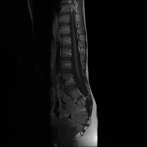 Tủy chẻ đôi (Diastematomyelia)