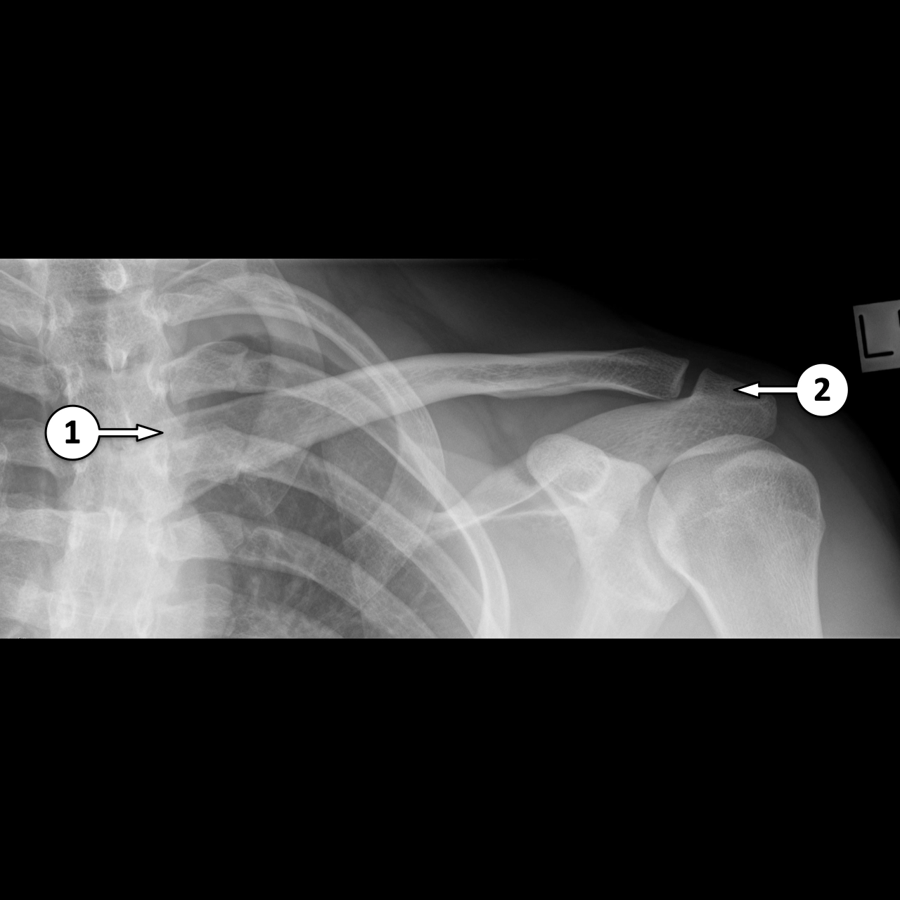 X Quang xương đòn