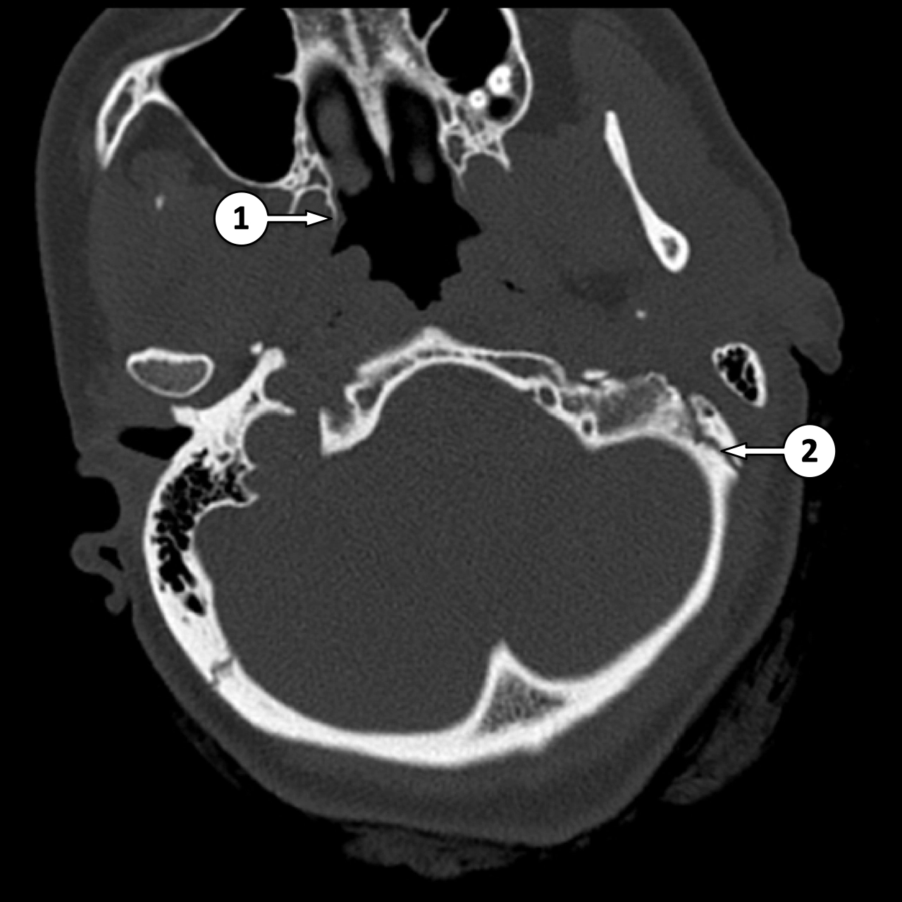 CT cột sống cổ