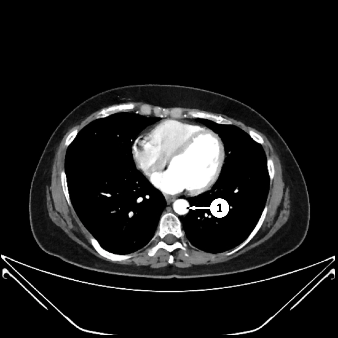 CTA mạch máu bụng