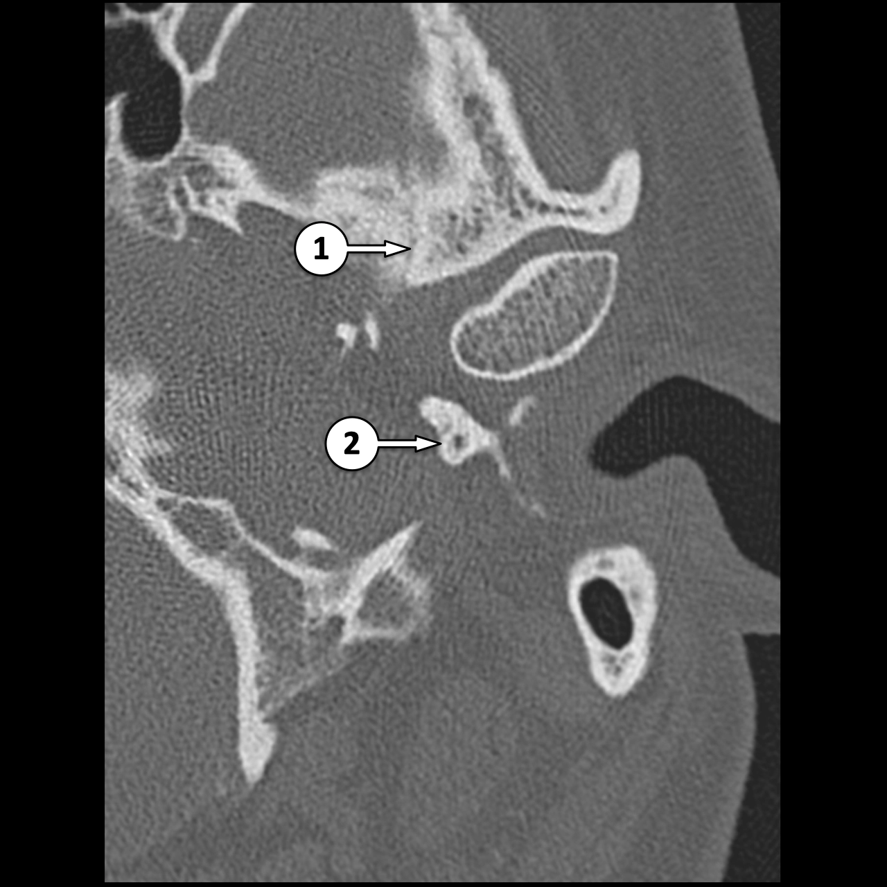 CT Xương thái dương