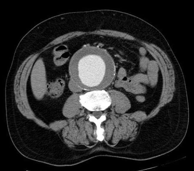 Phình động mạch chủ bụng (Abdominal Aortic Aneurysm - AAA)