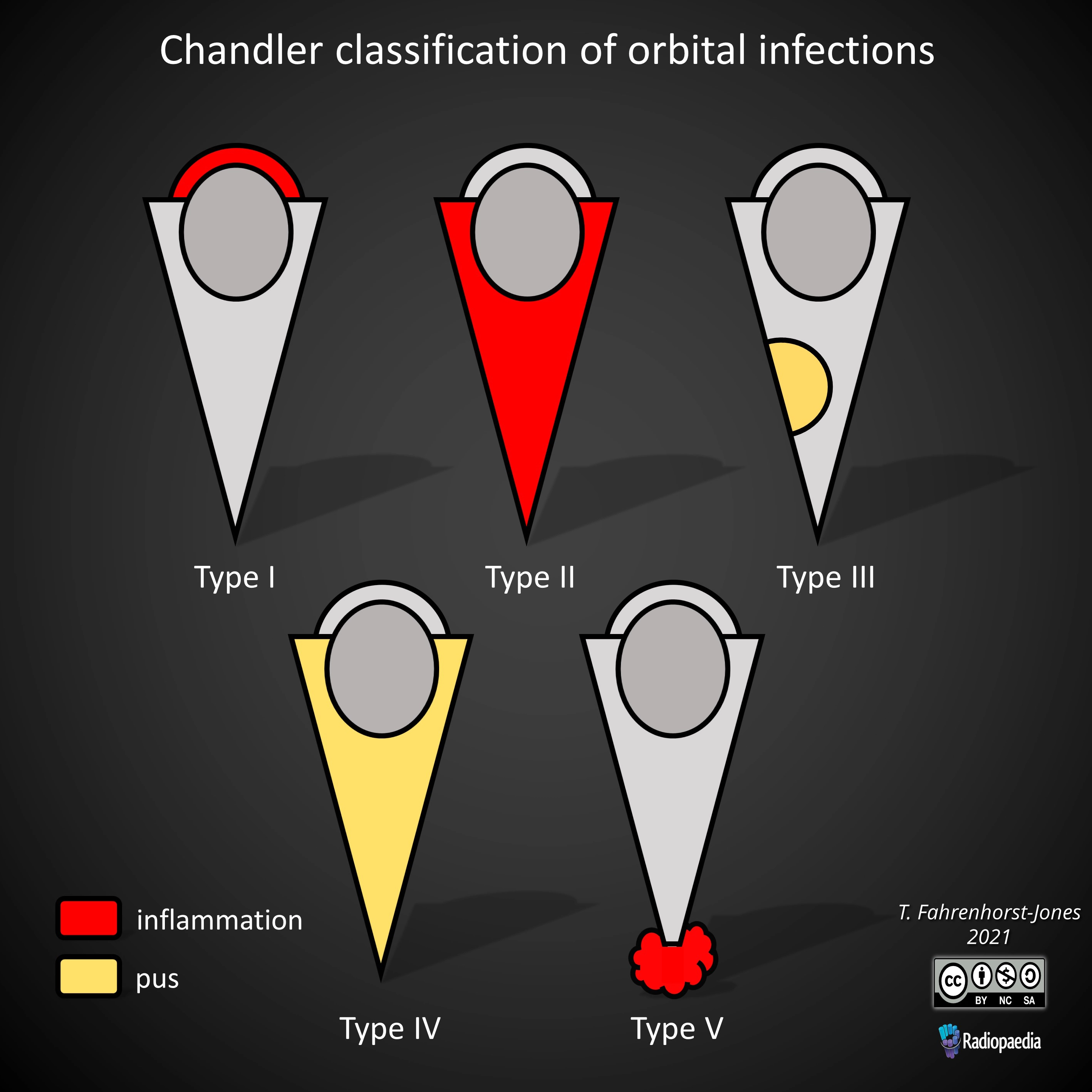 Nhiễm trùng ổ mắt (Orbital infection)