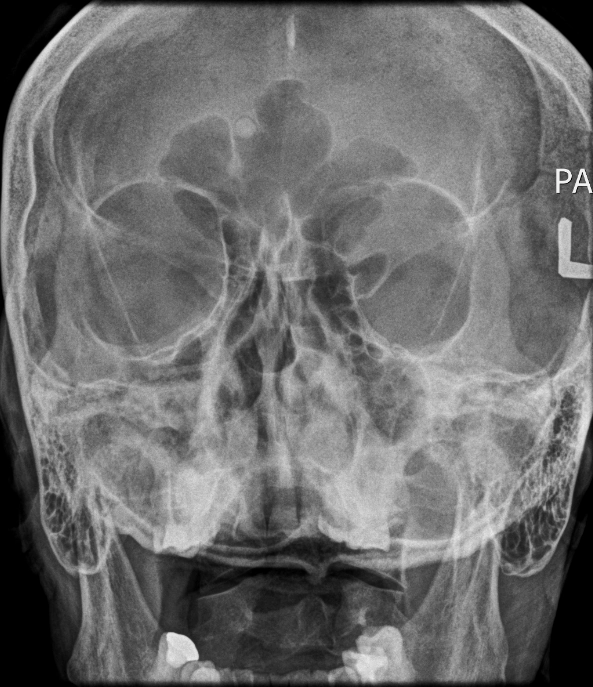 U xương mũi xoang (Paranasal sinus osteomas)