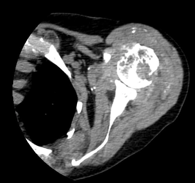Bệnh khớp do Amyloid (Amyloid arthropathy) 