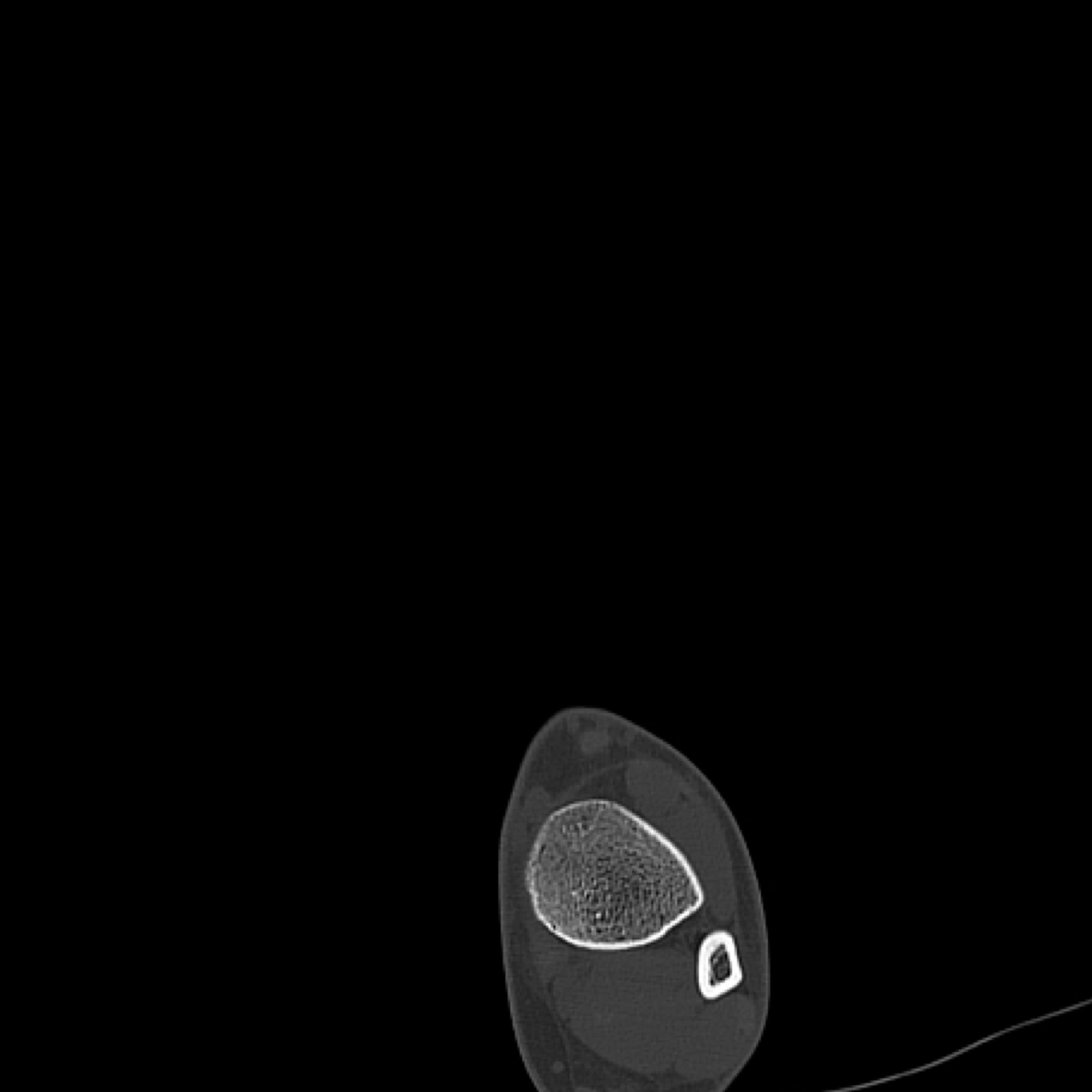 CT cổ chân &amp; bàn chân