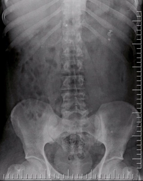 Bệnh đặc xương chậu (Osteitis condensans ilii)