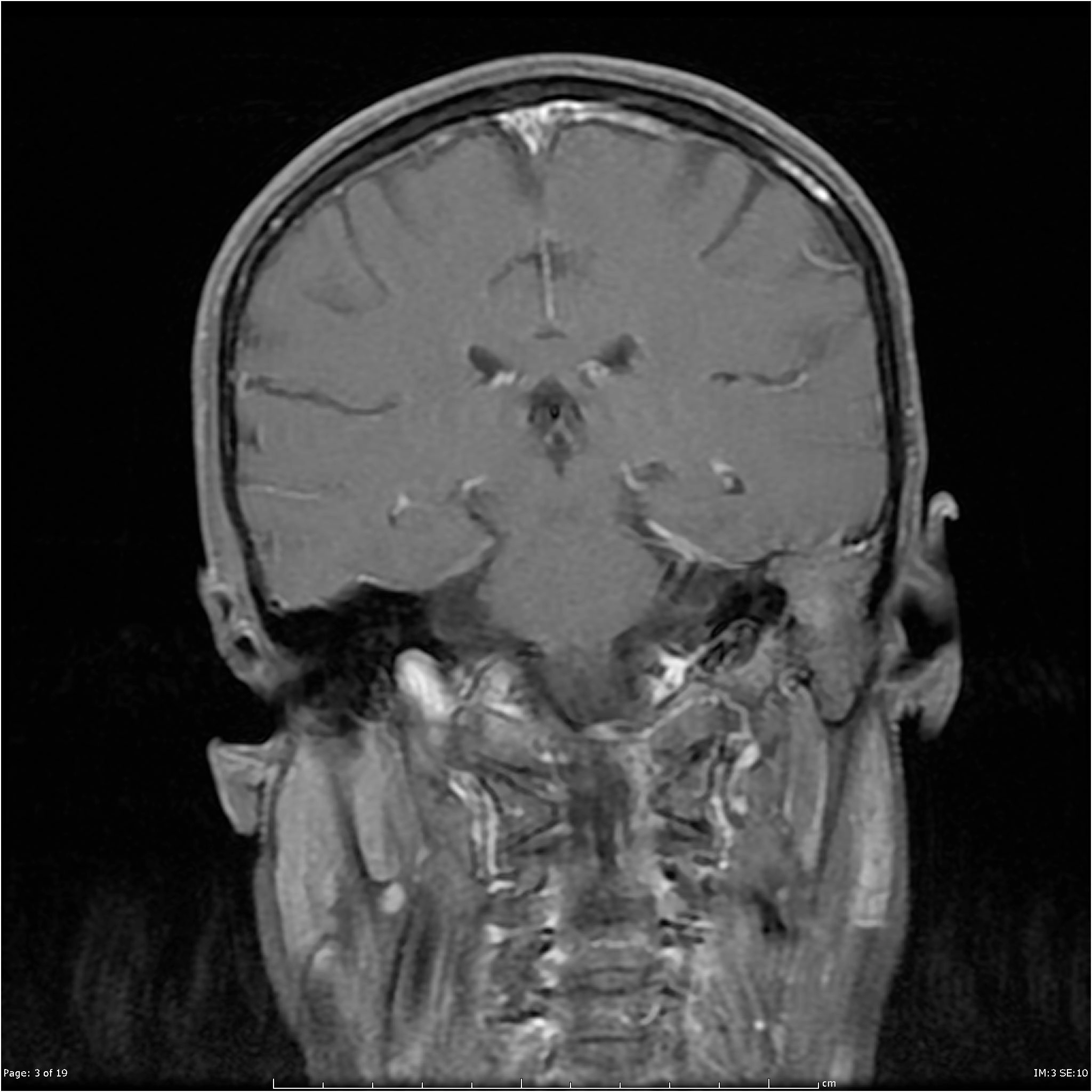 U màng não nền sọ (Skull base meningioma)