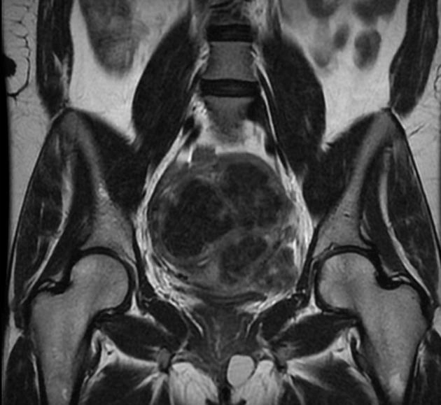 Nang tuyến Bartholin (Bartholin gland cyst)