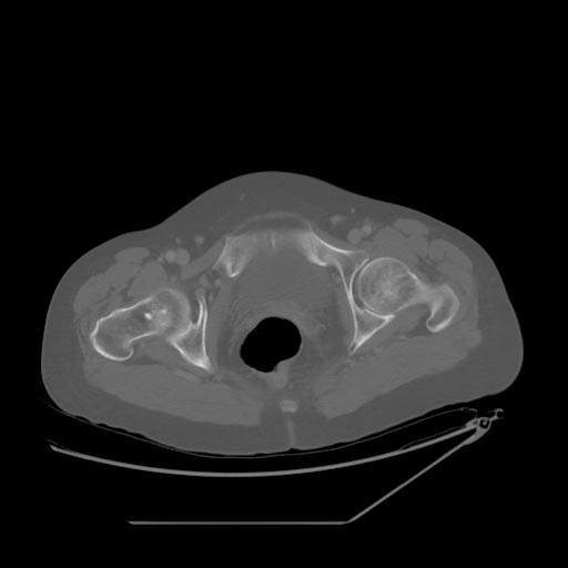 Đảo xương (Bone island)