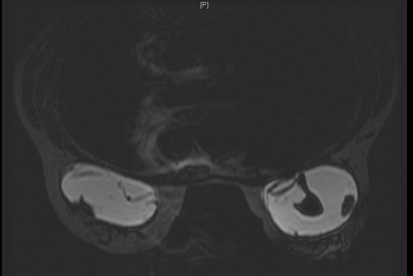 Vỡ túi ngực (Breast implant rupture)