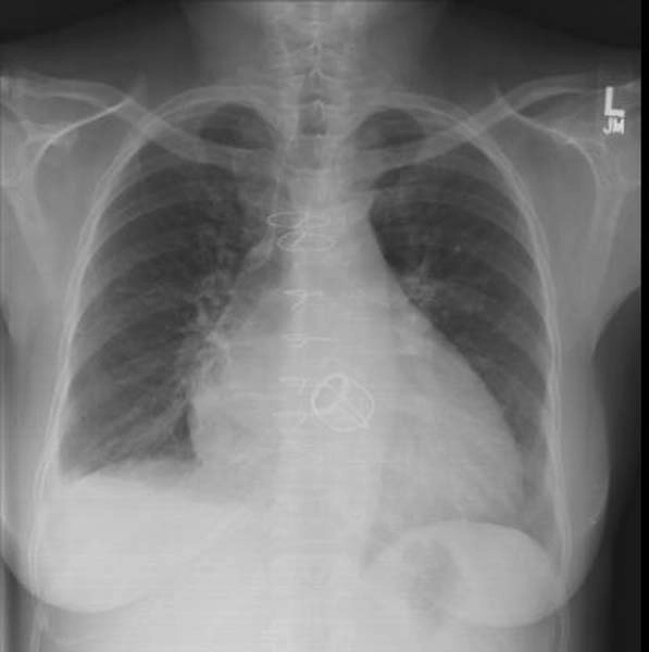 Tim to (Cardiomegaly)