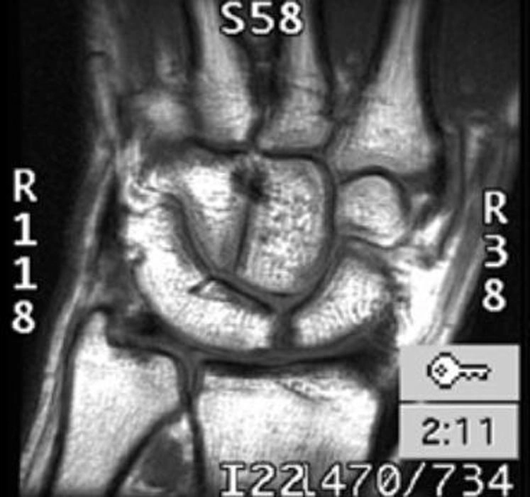 Dính xương cổ tay (Carpal coalition)