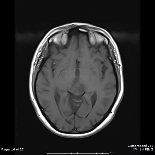 U nhú vùng tuyến tùng (Papillary tumor of the pineal region - PTPR)