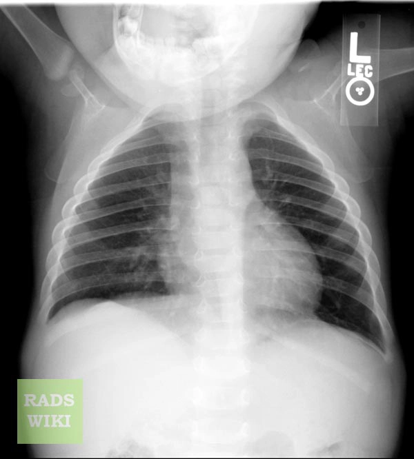 Bệnh loạn sản đòn-sọ (Cleidocranial dysplasia)