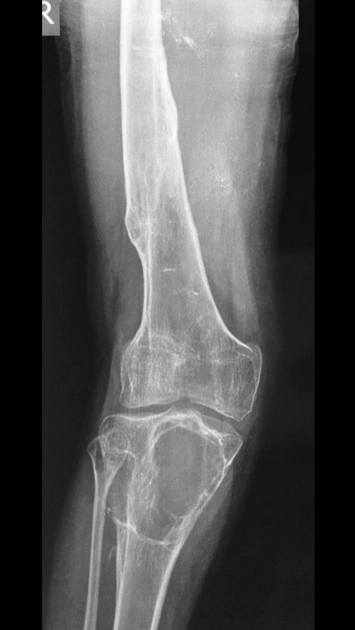 U giả do Hemophilia (Hemophilic pseudotumor)