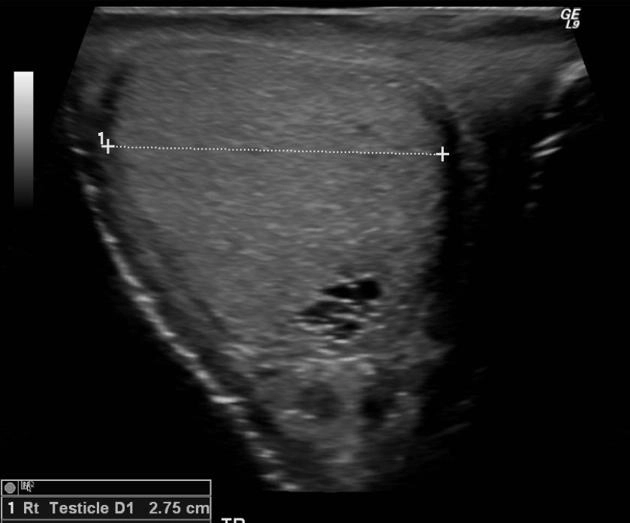 Giãn ống lưới tinh hoàn (Tubular ectasia of rete testis)