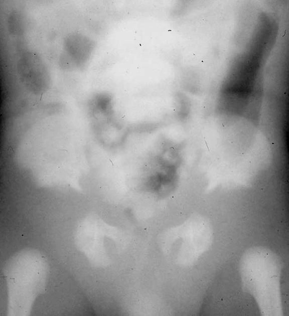 Loạn sản sụn-ngoại bì (Chondroectodermal dysplasia)