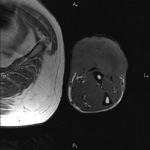 Sarcoma mạch máu ở mô mềm (Musculoskeletal angiosarcoma)