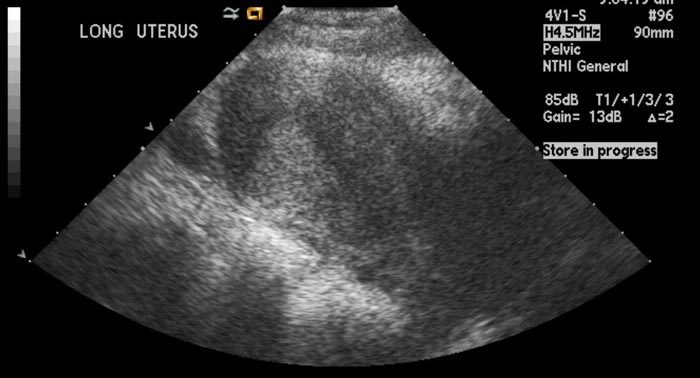 Polyp nội mạc tử cung (Endometrial polyp)