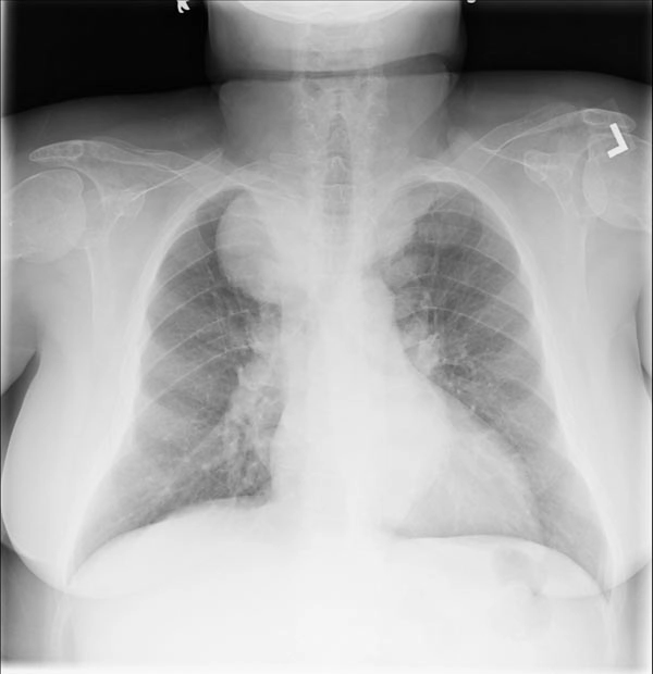 Tạo máu ngoài tủy (Extramedullary hematopoiesis)