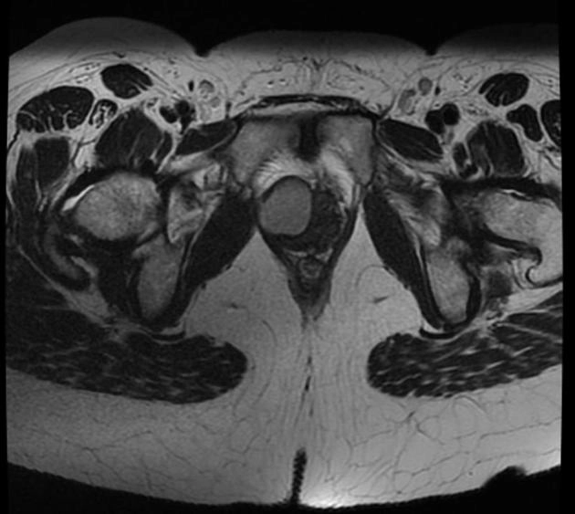 Nang ống Gartner (Gartner duct cyst)