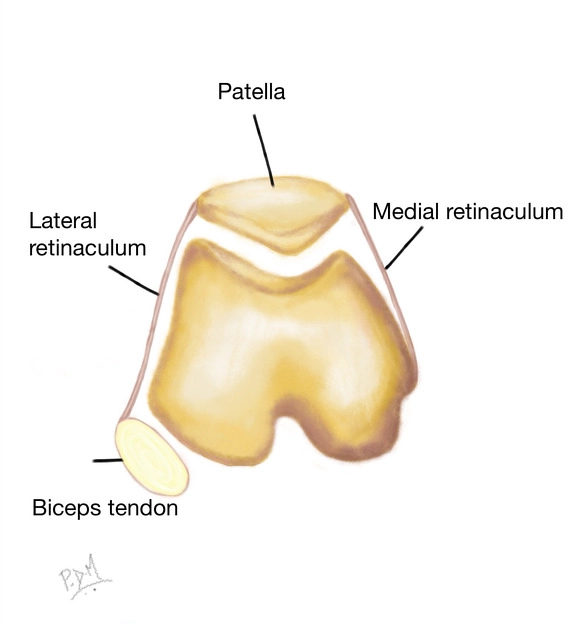 Trật xương bánh chè ra ngoài (Lateral patellar dislocation)