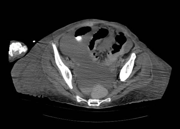 Tràn máu phúc mạc (Hemoperitoneum)