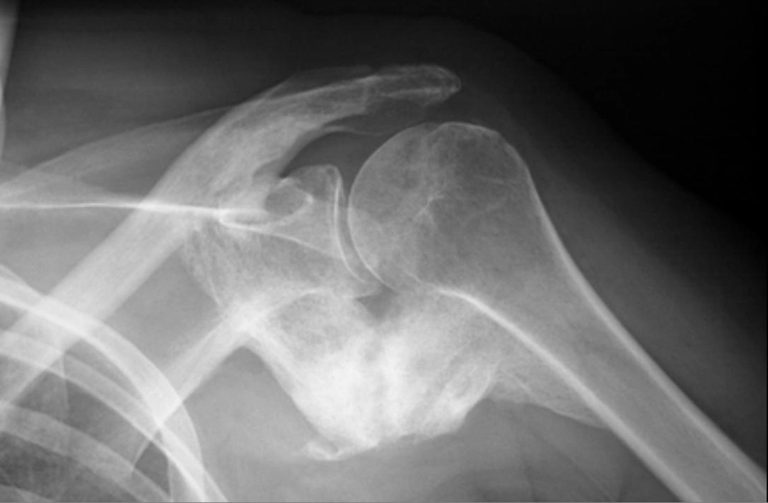 Cốt hóa lạc chỗ (Heterotopic ossification - HO)