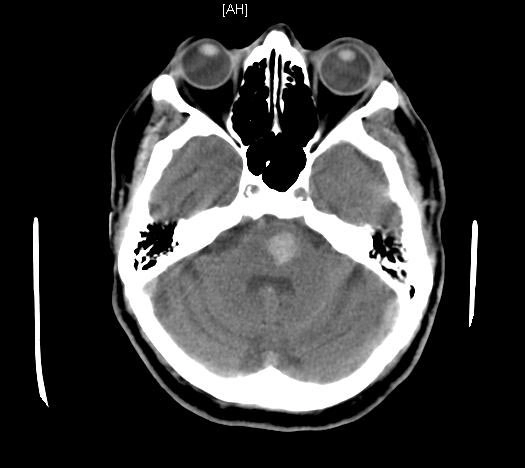 Xuất huyết não do tăng huyết áp (Hypertensive Intracerebral Hemorrhage - HICH)