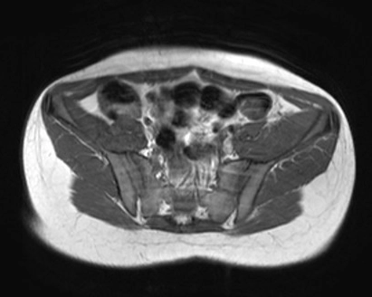 Viêm cơ nhiễm trùng (Infectious myositis)