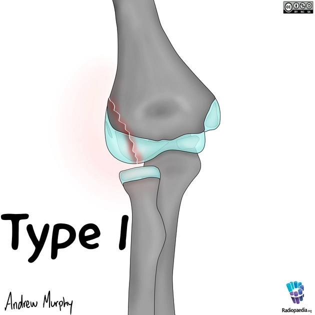 Gãy lồi cầu ngoài xương cánh tay (Lateral humeral condyle fracture)