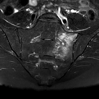 Gãy xương cùng do suy yếu (Sacral insufficiency fracture)/ gãy xương cùng do mỏi (stress fracture)