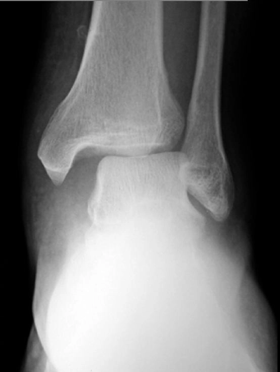 Gãy Maisonneuve (gãy đầu trên xương mác)