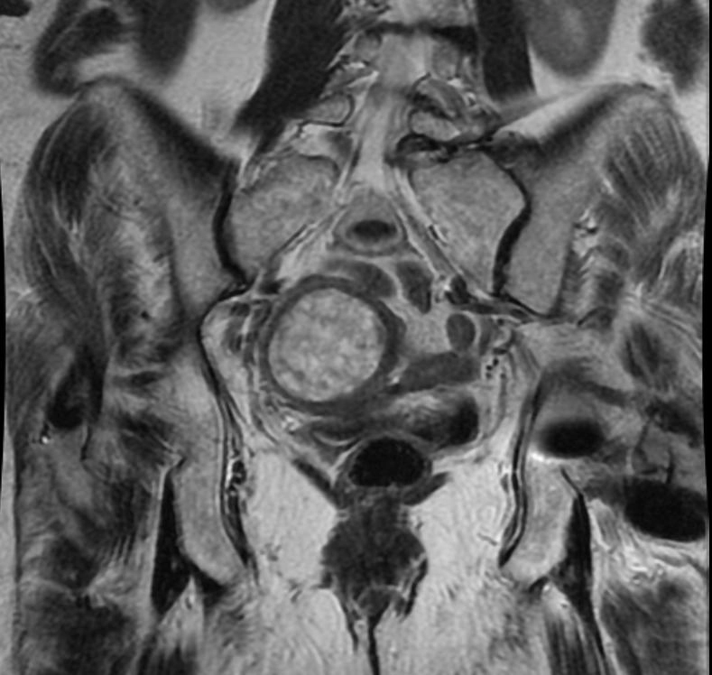 Carcinosarcoma tử cung (Carcinosarcoma of the uterus)