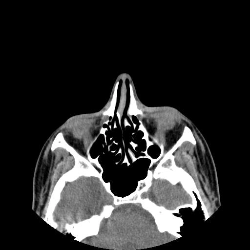 Dị dạng bạch mạch ổ mắt (Orbital lymphatic malformations)