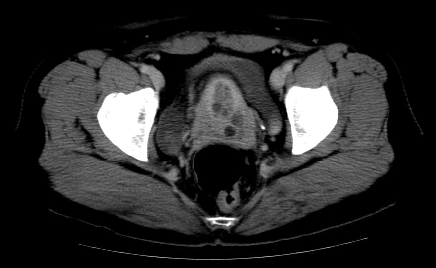 Nang Nabothian (Nabothian cyst)