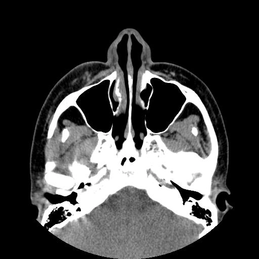Viêm tuyến lệ (Dacryoadenitis)