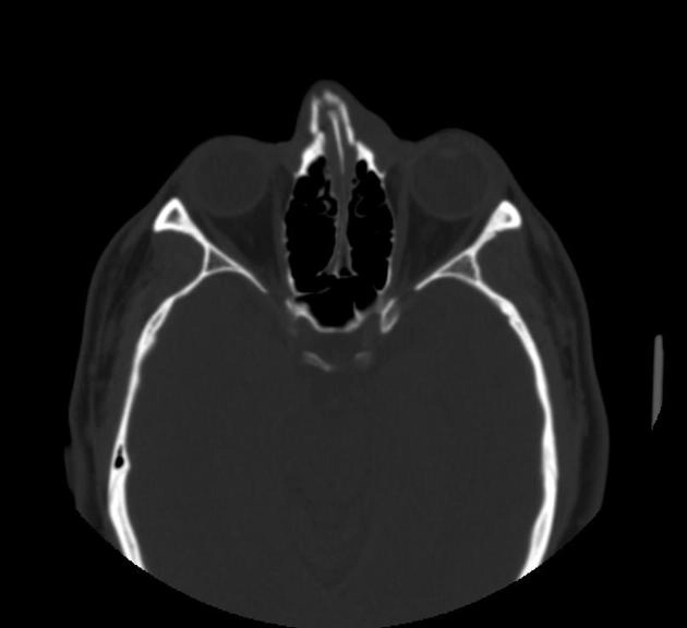 Gãy xương mũi (Nasal bone fractures)