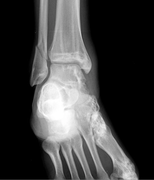 Bệnh xương sọc (Osteopathia striata)