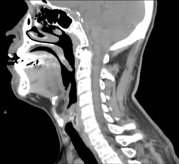 Đốt sống chẩm (Occipital vertebrae)
