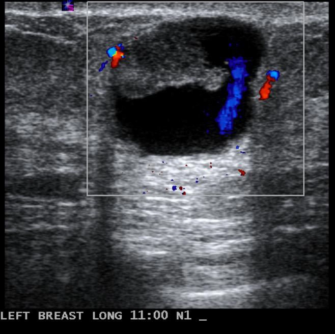 Nang phức hợp ở vú (Complex cystic and solid breast mass)