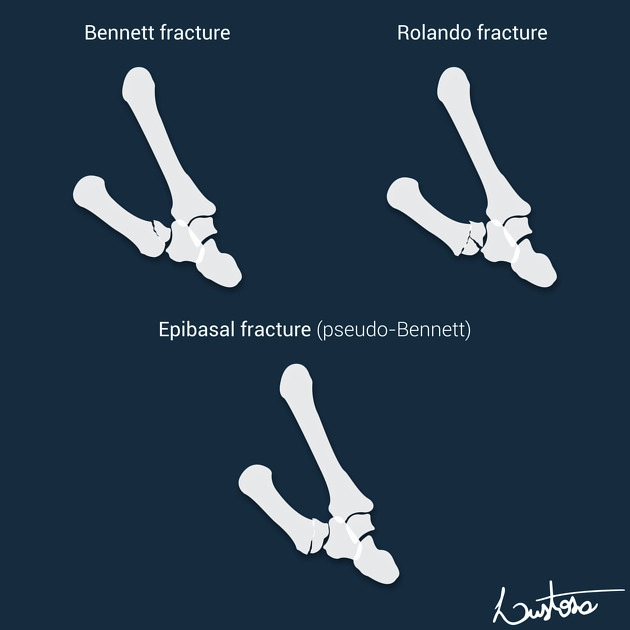 Gãy xương ngón tay cái (Fractures of the thumb)