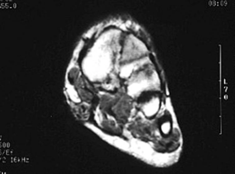 U xơ gan chân (Plantar fibromatosis) 