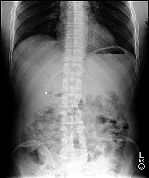 Khí trong đường mật (Pneumobilia)